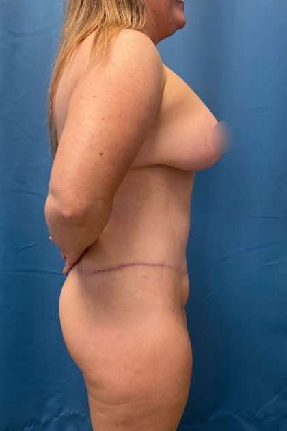 Lower Body Lift Before & After Patient #1200