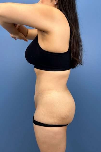 Lower Body Lift Before & After Patient #1213
