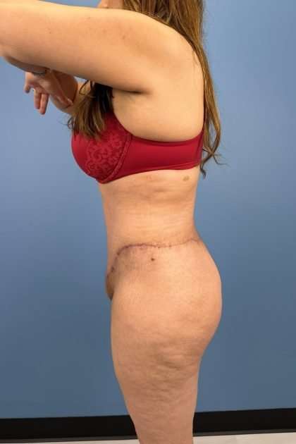 Lower Body Lift Before & After Patient #1226