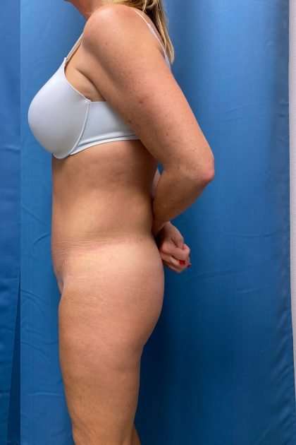 Lower Body Lift Before & After Patient #1239