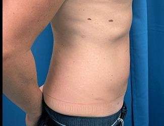Liposuction Before & After Patient #1257