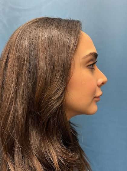 Lip Lift Before & After Patient #1279