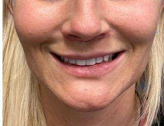 Lip Lift Before & After Patient #1289