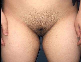 Labiaplasty Before & After Patient #2772