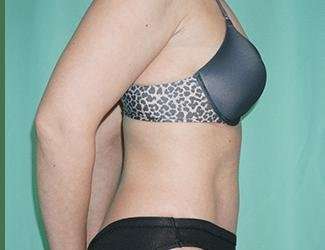 Tummy Tuck Before & After Patient #340