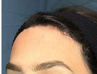 Forehead Reduction Before & After Patient #1364