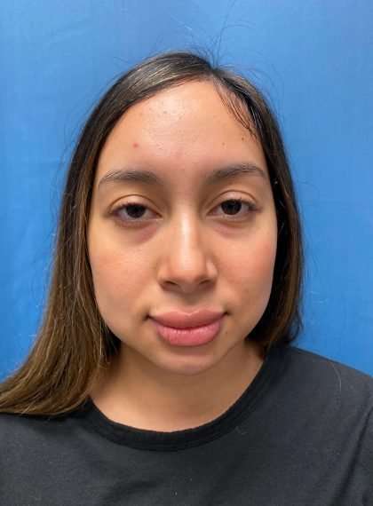 Forehead Reduction Before & After Patient #1371