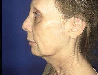 Facial Implants Before & After Patient #1392