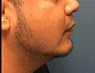 Facial Implants Before & After Patient #1403