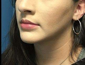 Facial Implants Before & After Patient #1453