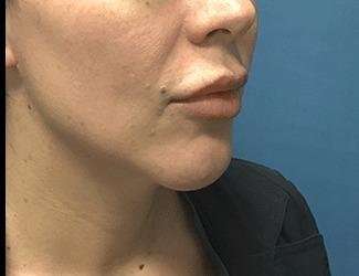 Facial Implants Before & After Patient #1464
