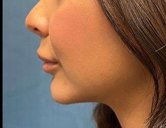 Facial Implants Before & After Patient #1475