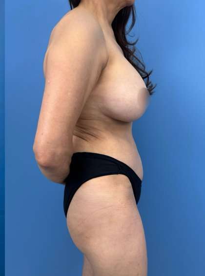 Tummy Tuck Before & After Patient #253