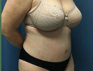 Tummy Tuck Before & After Patient #380