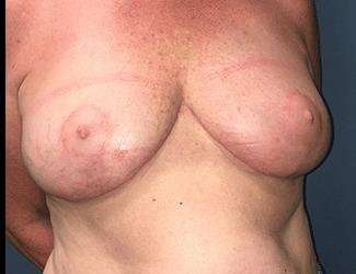 Breast Reduction Before & After Patient #1760