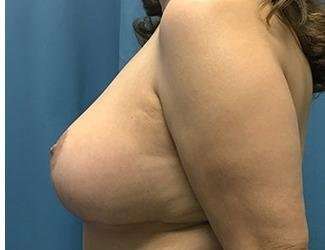 Breast Reduction Before & After Patient #1782