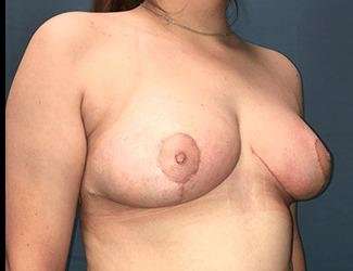 Breast Reduction Before & After Patient #1793