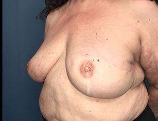 Breast Reduction Before & After Patient #1815