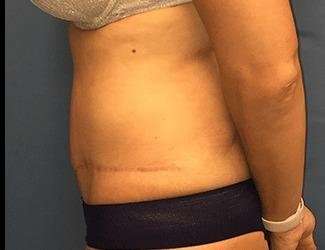Tummy Tuck Before & After Patient #395