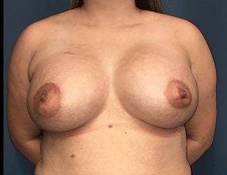 Breast Lift Before & After Patient #1903