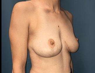 Breast Lift Before & After Patient #1923