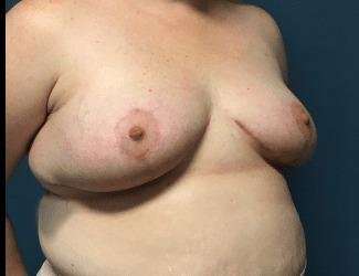 Breast Lift Before & After Patient #1934
