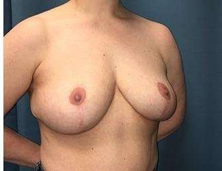 Breast Lift Before & After Patient #1945