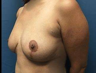 Breast Lift Before & After Patient #1965