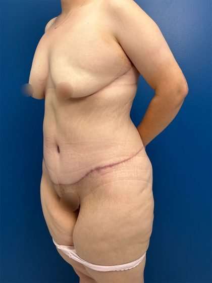Tummy Tuck Before & After Patient #406