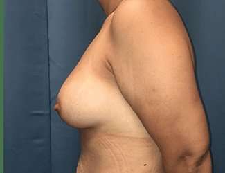 Breast Augmentation Before & After Patient #2091