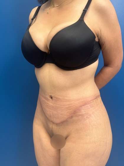 Tummy Tuck Before & After Patient #417