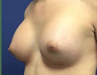 Breast Augmentation Before & After Patient #2102