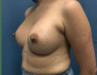 Breast Augmentation Before & After Patient #2133
