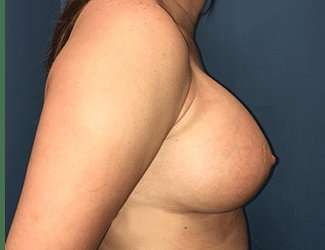 Breast Augmentation Before & After Patient #2144