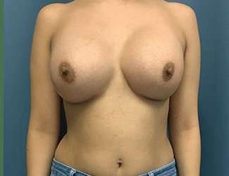 Breast Augmentation Before & After Patient #2153