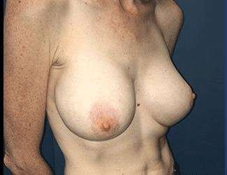 Breast Augmentation Before & After Patient #2162