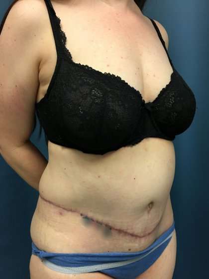Tummy Tuck Before & After Patient #428