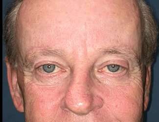 Blepharoplasty Before & After Patient #2251