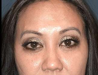 Blepharoplasty Before & After Patient #2260