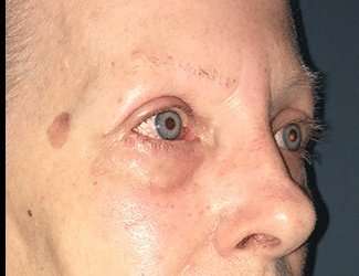 Blepharoplasty Before & After Patient #2271
