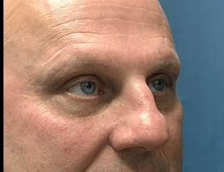 Blepharoplasty Before & After Patient #2282