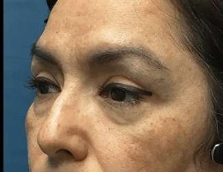 Blepharoplasty Before & After Patient #2293