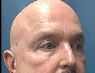 Blepharoplasty Before & After Patient #2328