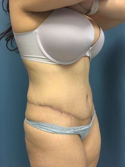 Tummy Tuck Before & After Patient #439