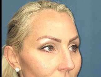 Blepharoplasty Before & After Patient #2339