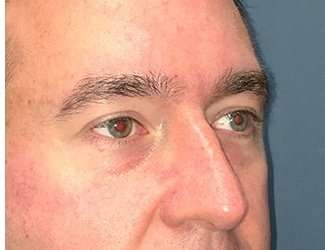 Blepharoplasty Before & After Patient #2352