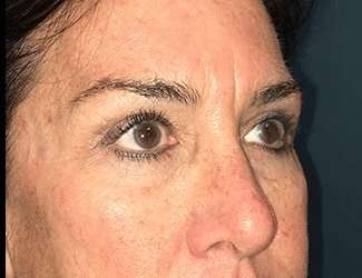 Blepharoplasty Before & After Patient #2368