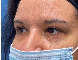 Blepharoplasty Before & After Patient #2385