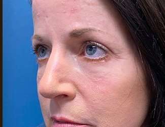 Blepharoplasty Before & After Patient #2408