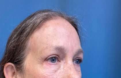 Blepharoplasty Before & After Patient #2419